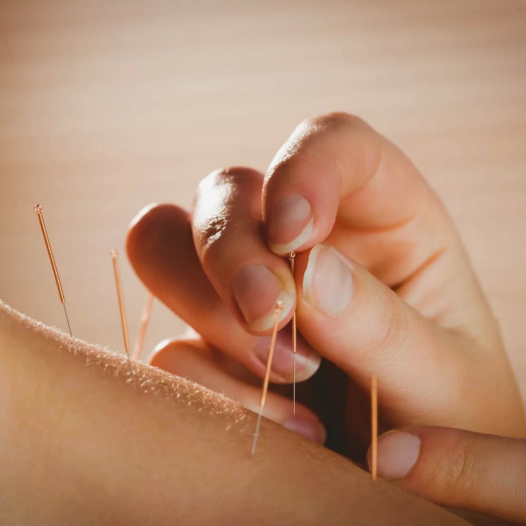 Acupuncture